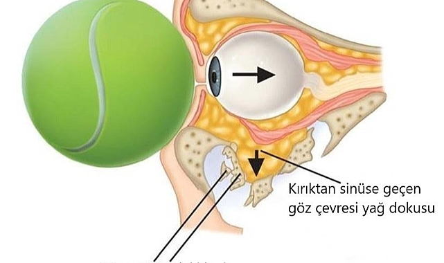 TENİS'te POTANSİYEL TEHLİKE: BLOW OUT KIRIKLARI!